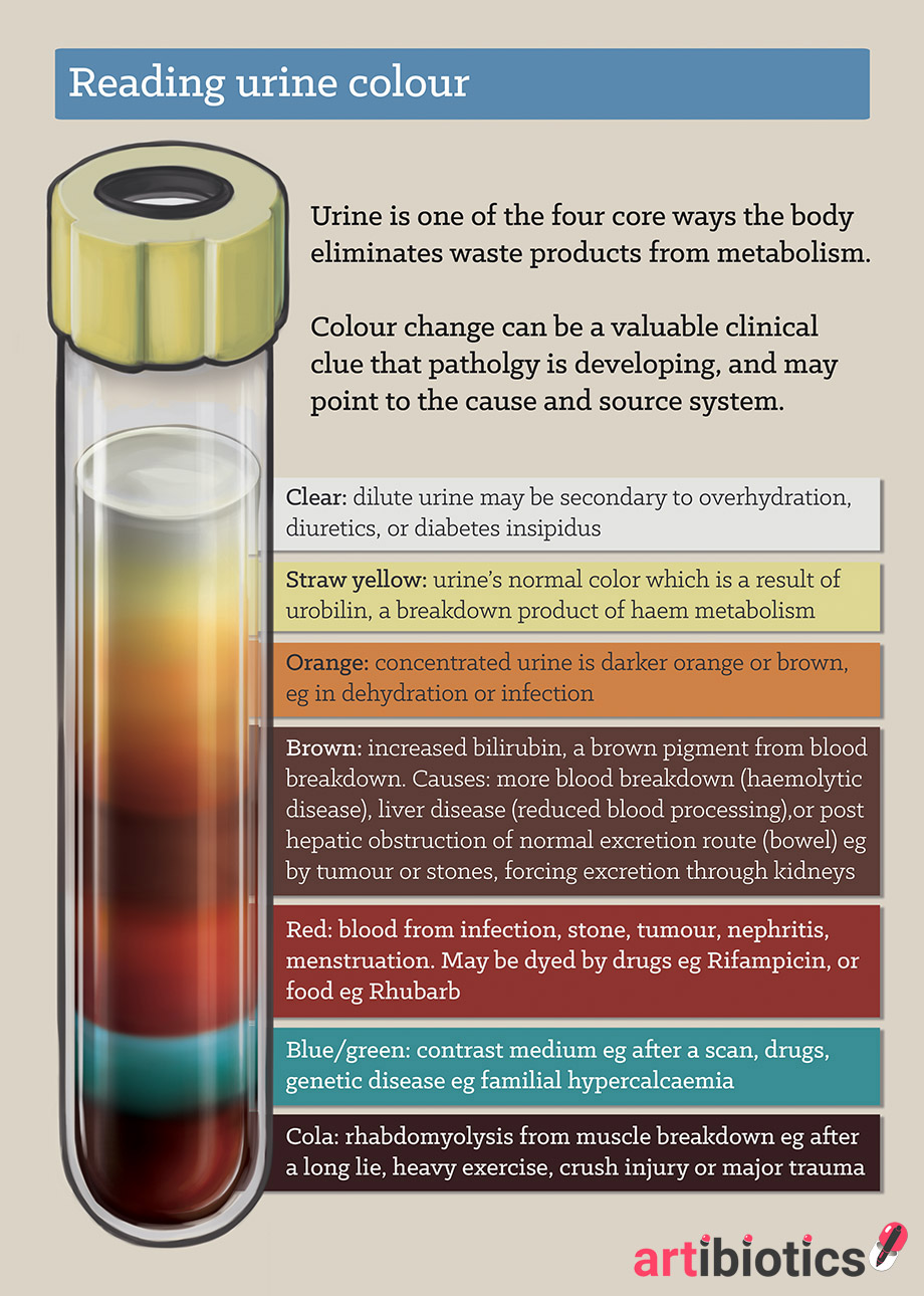 Dark Urine Could Indicate a Liver Problem